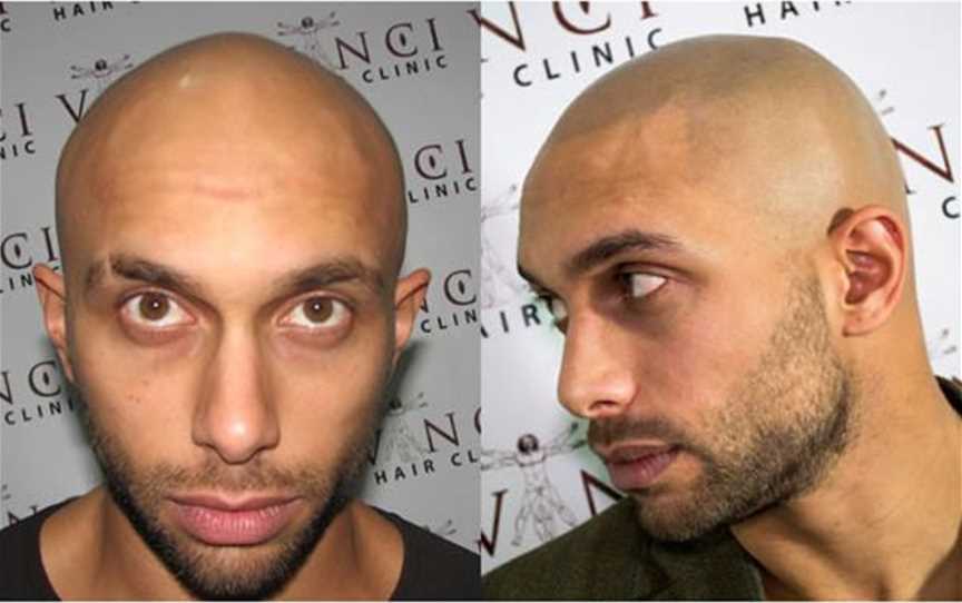 Before and after Scalp MicroPigmentation treatment