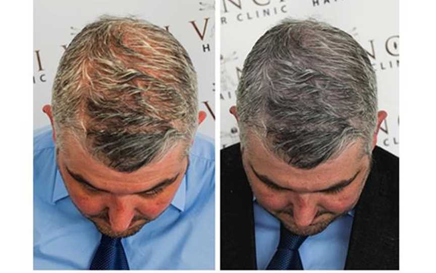Disguise thinning hair with SMP treatment.