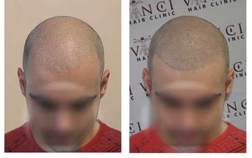 Before and after Scalp MicroPigmentation treatment